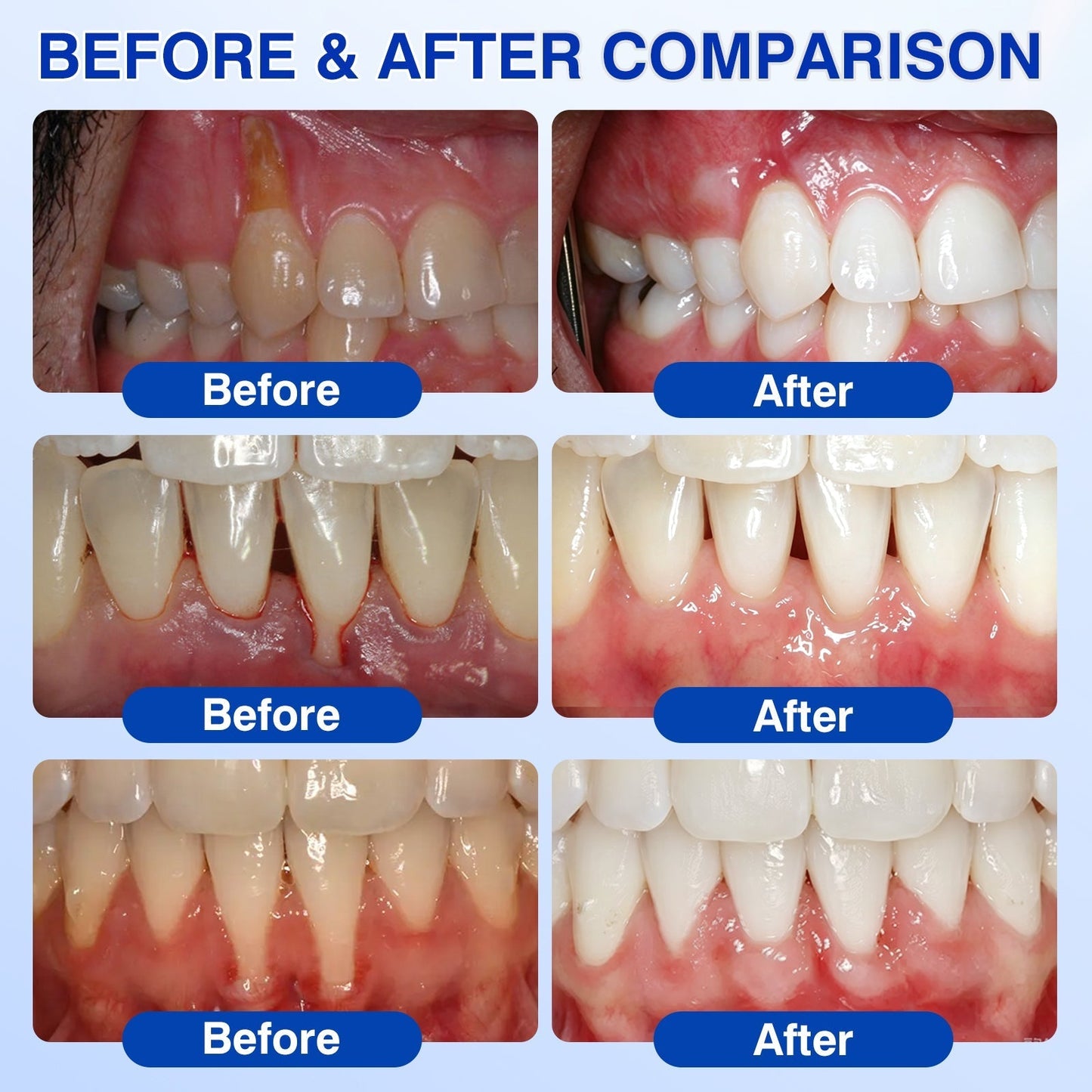 🇨🇦👨‍⚕️🦷🛡️YAGOO® Periodontal Repair Gel